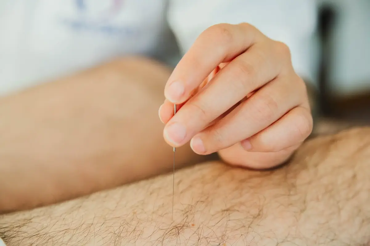 Práctica de acupuntura en una formación Cenakin